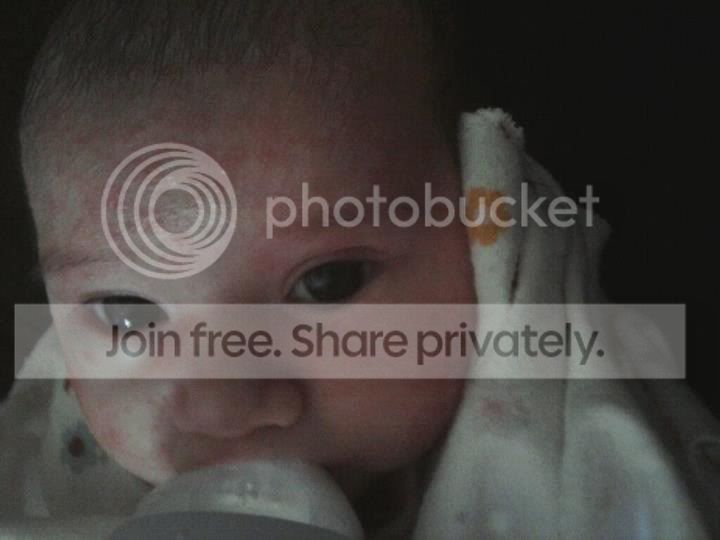 selsun blue for baby acne